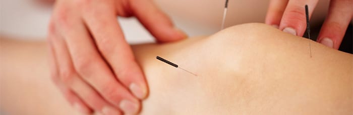 tecnica dry needling ginocchio