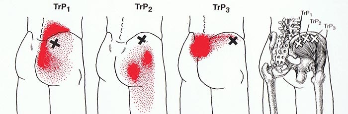 trigger point medio gluteo