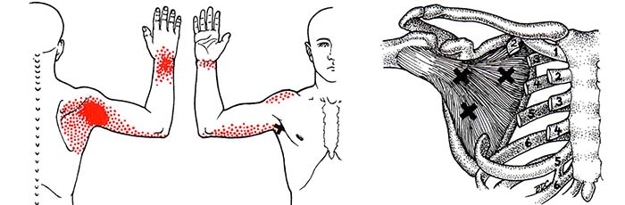 trigger point muscolo sottoscapolare